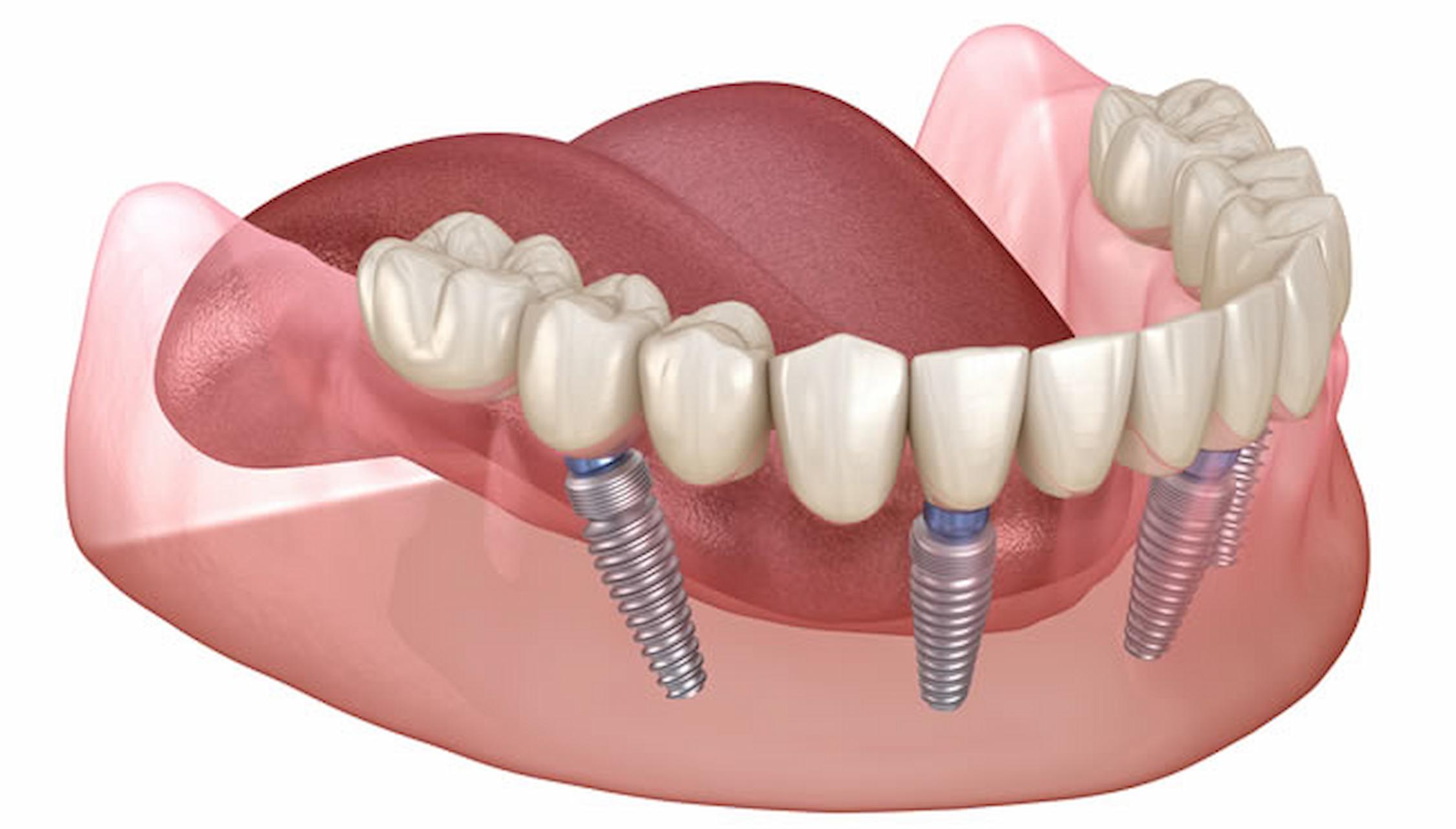 Why Do You Need To Get A Dental Implant?