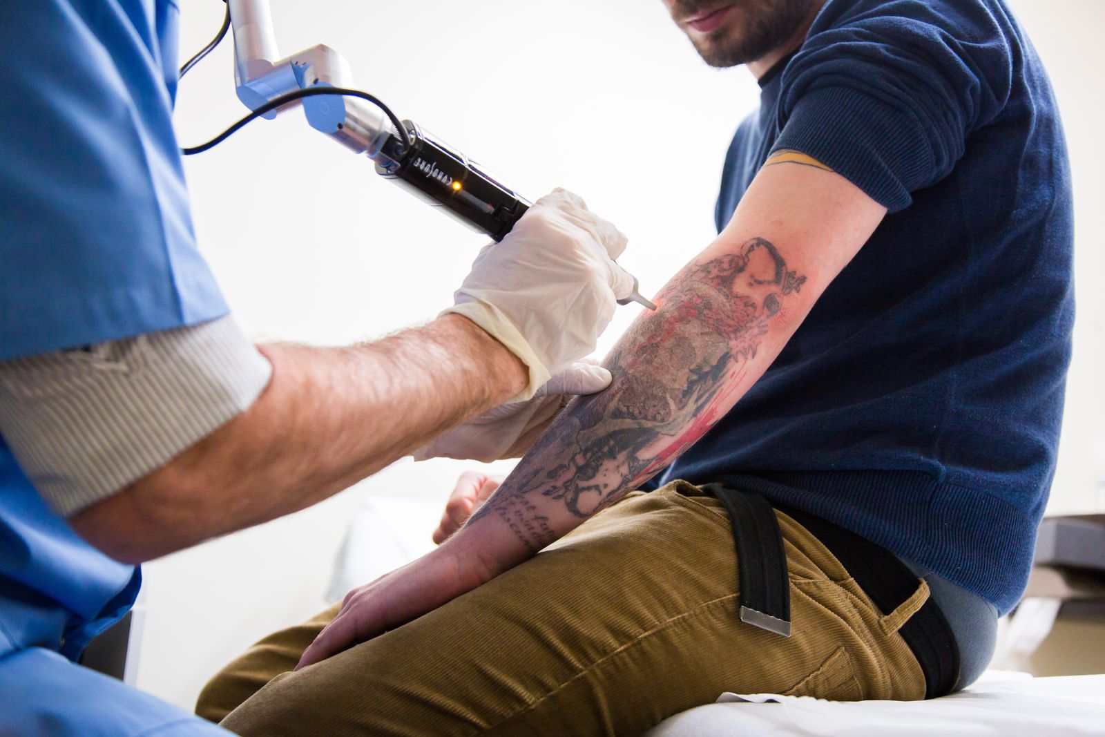 5 Facts You Need To Know Before Getting A Tattoo Removed